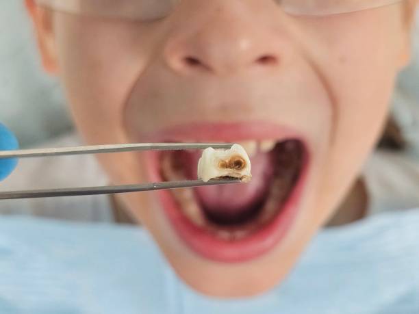 Best Cracked Tooth Emergency Dentist  in Amberley, OH