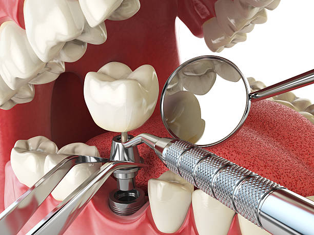 Best Chipped Tooth Repair Near Me  in Amberley, OH